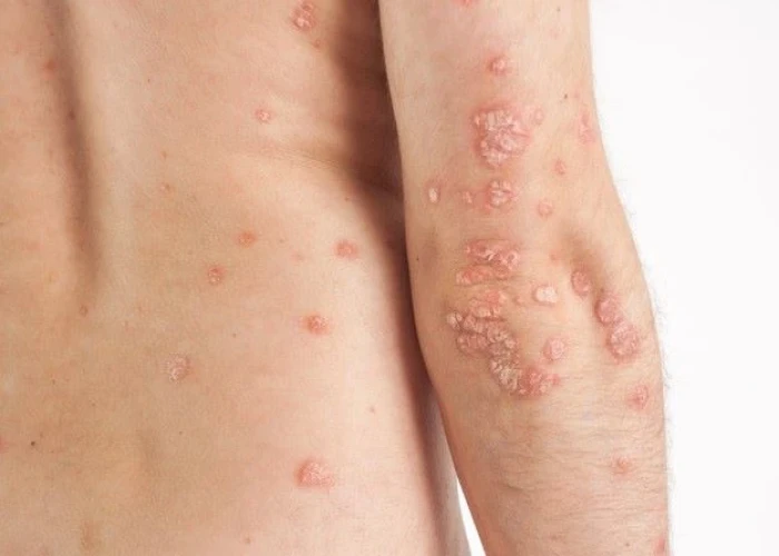Neurodermatitis