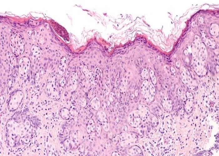 Paget's disease of the breast