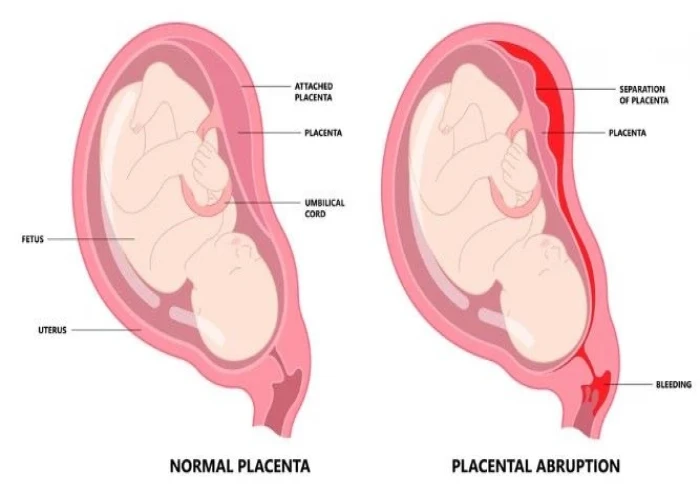 Placenta accreta