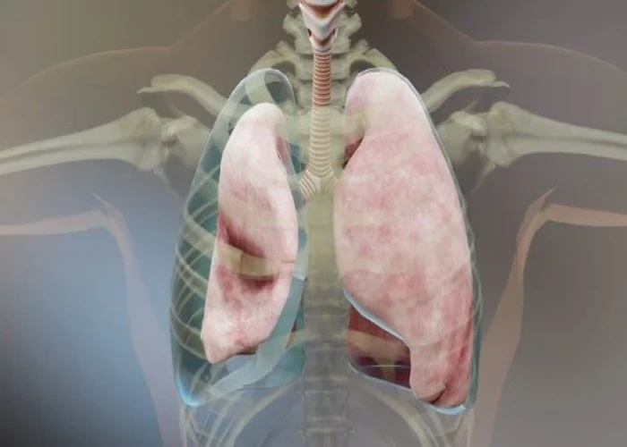 Pneumothorax