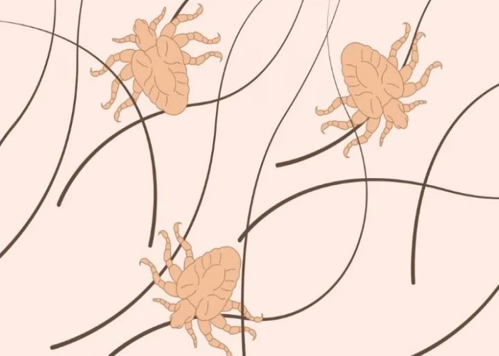 Pubic lice (crabs)
