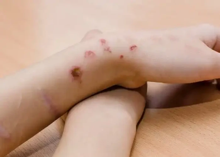 Self-injury / cutting