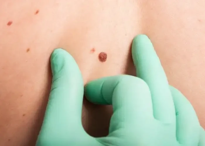 Skin cancer