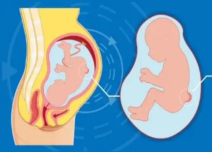Spina bifida