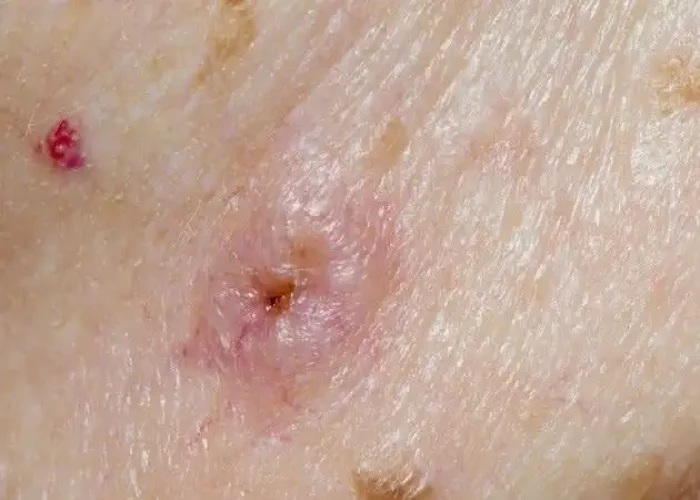 Staph infections
