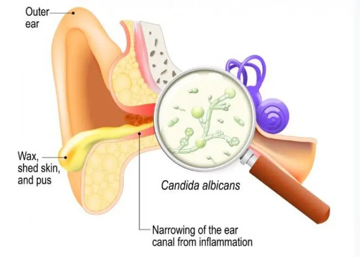 Swimmer's ear