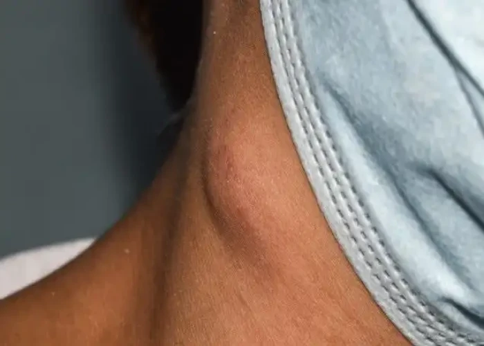 Swollen lymph nodes