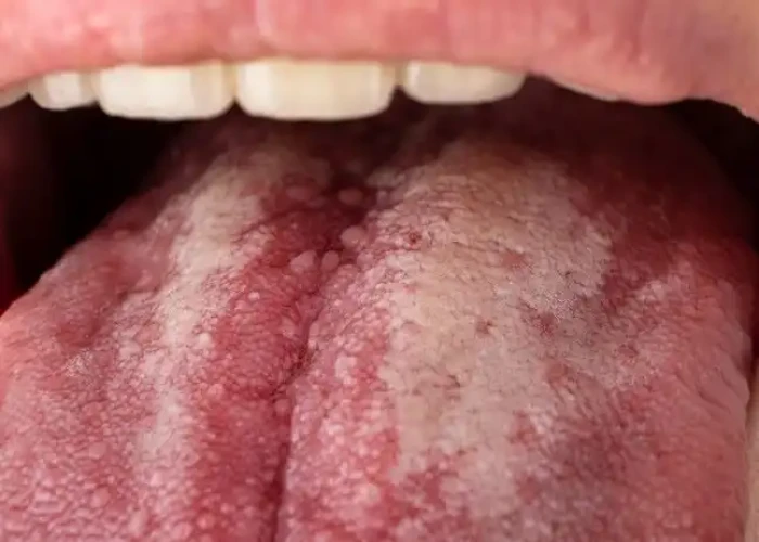 Tongue cancer