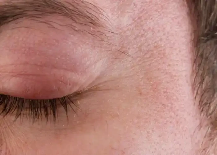 Trachoma