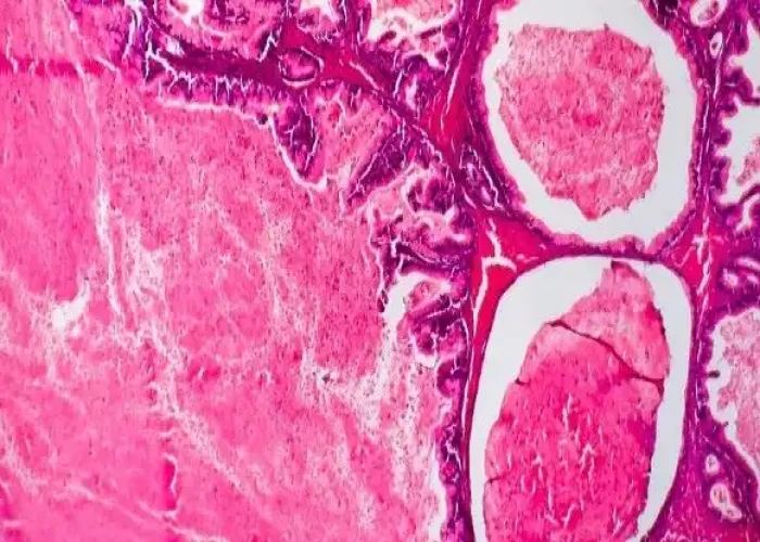 Undifferentiated pleomorphic sarcoma