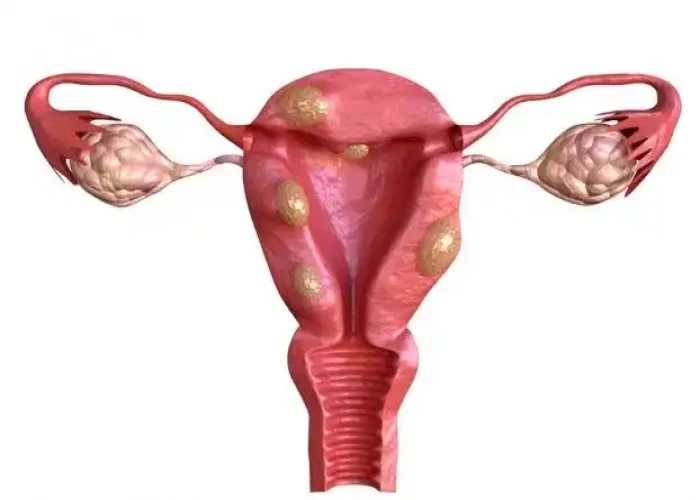 Uterine fibroids