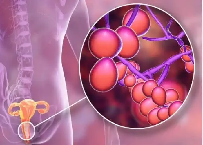 Yeast infection (vaginal)