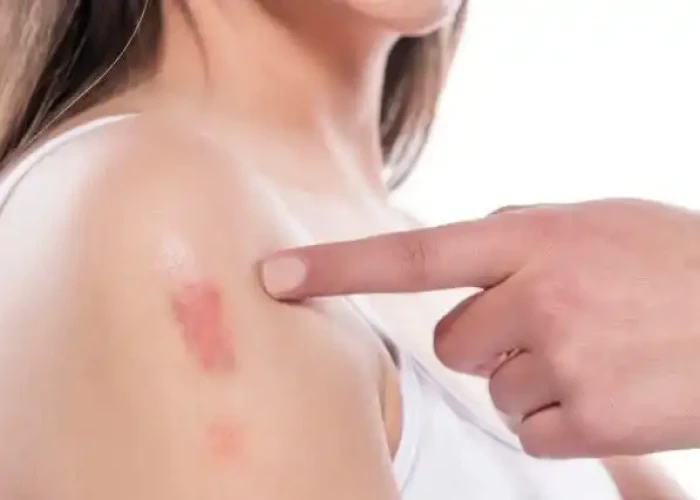 Tuberculosis of Skin (Lupus Valgaris)