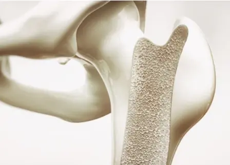 Bone disease