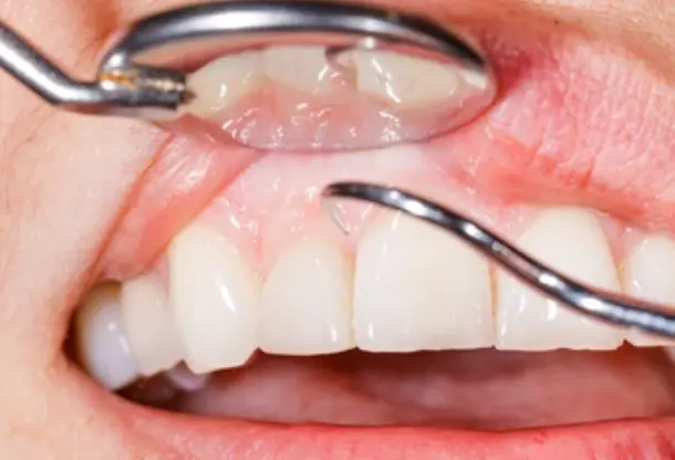 Dental disease