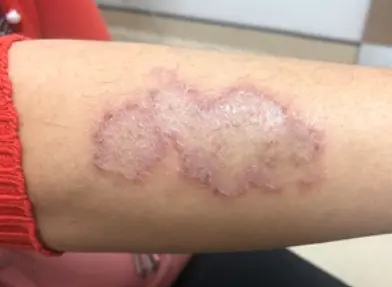 Fungal disease
