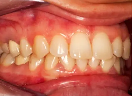 Gum disease