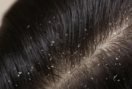Hair disease