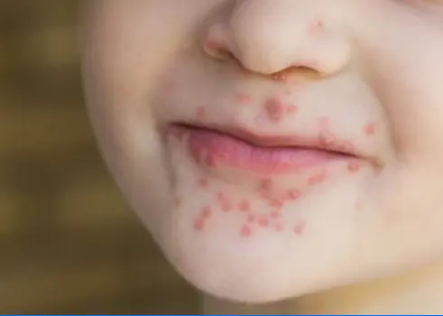 Mouth disease