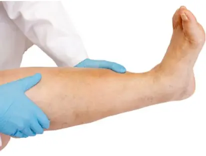 Oedema
