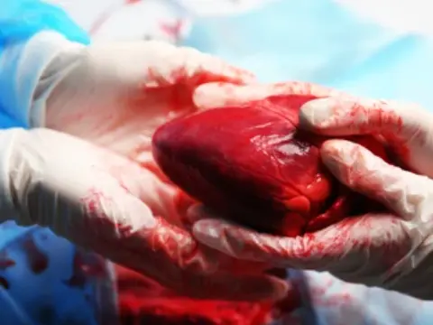 Organ transplantation