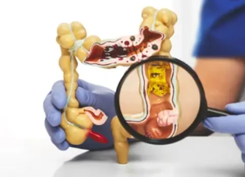 Rectum disease