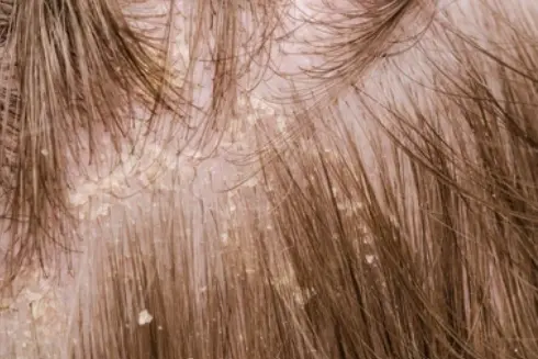 Scalp disease