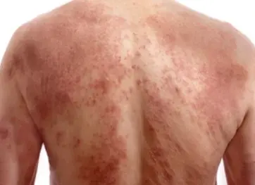 Skin disease