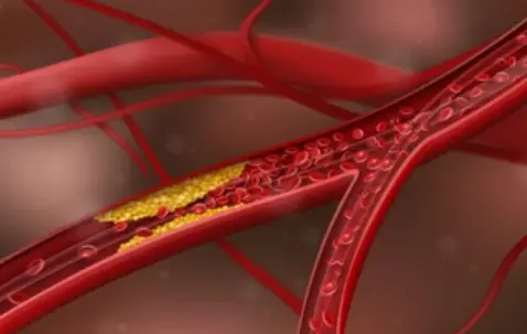 Vein disease