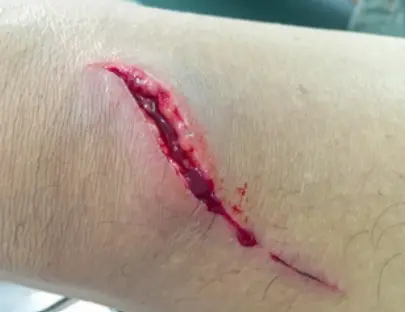 Wounds