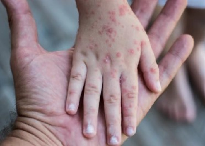 Pox